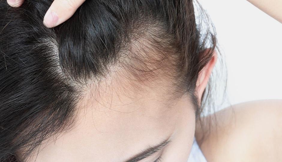 Frontal Fibrosing Alopecia What Is It Unique Hair Concepts